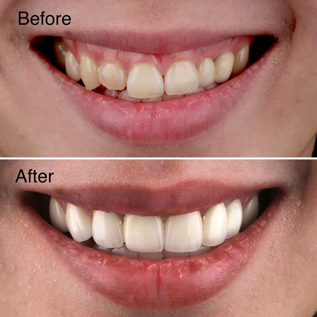 Removable Dental Veneers – Instant Smile & Natural-Looking Teeth Cover