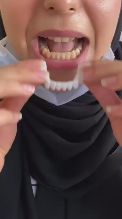 Removable Dental Veneers – Instant Smile & Natural-Looking Teeth Cover